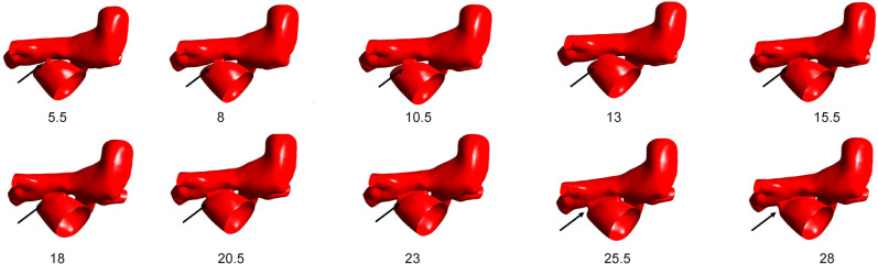 Numerical modeling assisting in surgical treatment of total anomalous pulmonary venous connection in children.