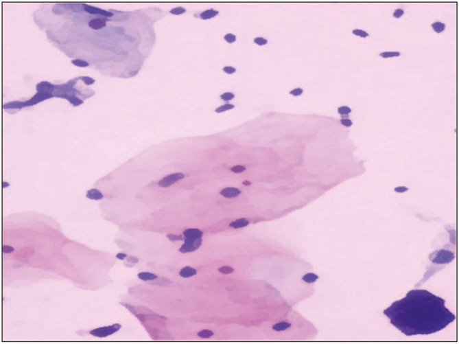 A Diagnostic Study Using STARD Platform on Liquid-Based Cytology in Cervical Smear and Its Positivity Rate among Females with Abnormal Vaginal Conditions Attending a Tertiary Care Center.