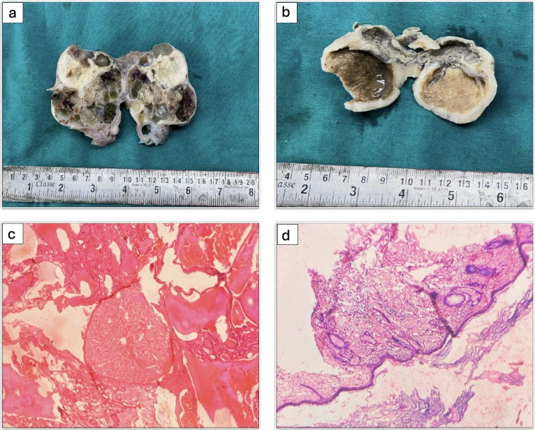 Unveiling the Uncommon: A Case Series on Rare Germ Cell Tumors.