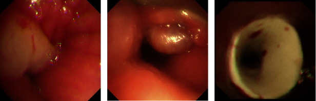 Clinical Analysis of 32 Cases of Subglottic Benign Airway Stenosis Treated With Montgomery T Silicone Stent.