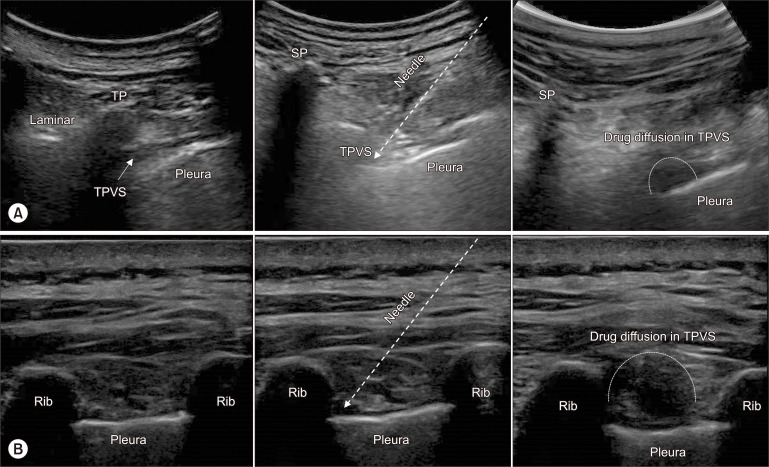 Assessment of ultrasound-guided intercostal nerve block for acute herpes zoster and its' possible prophylaxis for postherpetic neuralgia: a retrospective and case-controlled trial.