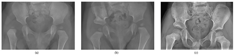 Outcomes of open reduction for hip dislocations in children with connective tissue disorders.