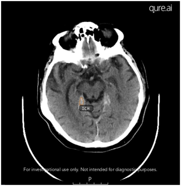 A retrospective audit of an artificial intelligence software for the detection of intracranial haemorrhage used by a teleradiology company in the United Kingdom.