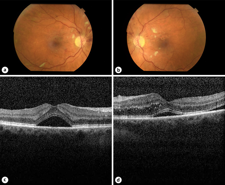 Working under Pressure: Scleroderma Presenting with Bilateral Exudative Retinal Detachment in the Context of Scleroderma Renal Crisis: A Case Report.