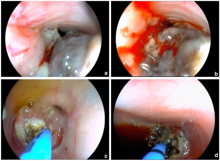 First description of oesophageal melanoma in a cat and palliative treatment by endoscopic argon plasma coagulation laser.