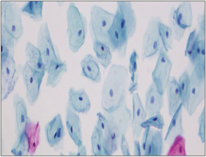 A Diagnostic Study Using STARD Platform on Liquid-Based Cytology in Cervical Smear and Its Positivity Rate among Females with Abnormal Vaginal Conditions Attending a Tertiary Care Center.