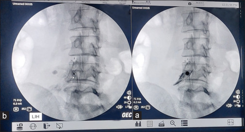 Correlation of perfusion index change and analgesic efficacy in transforaminal steroid injection for lumbosacral pain, a prospective observational study.