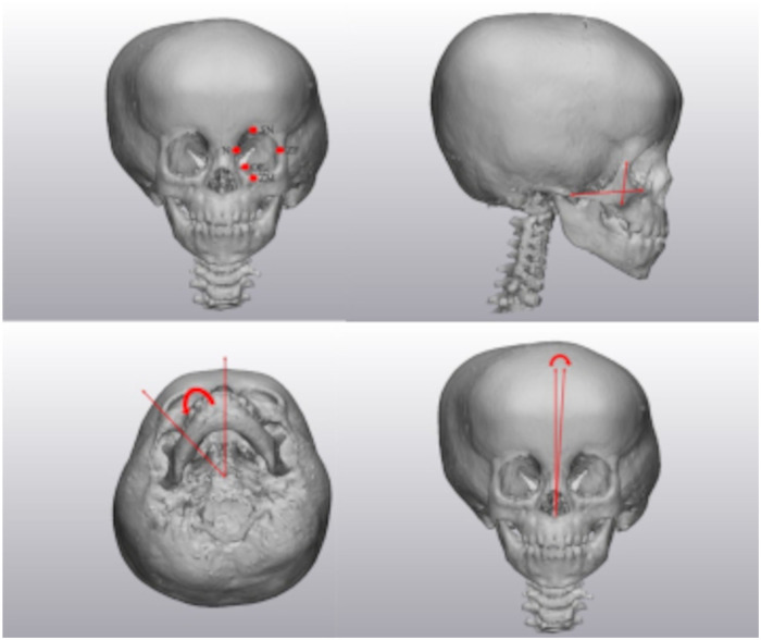 Three-dimensional Analysis of Facial Asymmetry in Unilateral Lambdoid Craniosynostosis.