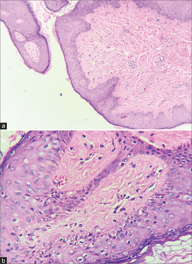 Dermoscopy of nevoid hyperkeratosis of the nipple and/or areola in Fitzpatrick skin type IV.