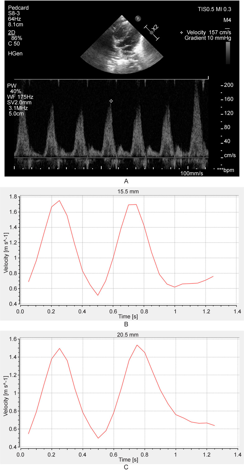 Numerical modeling assisting in surgical treatment of total anomalous pulmonary venous connection in children.