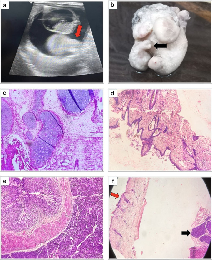 Unveiling the Uncommon: A Case Series on Rare Germ Cell Tumors.