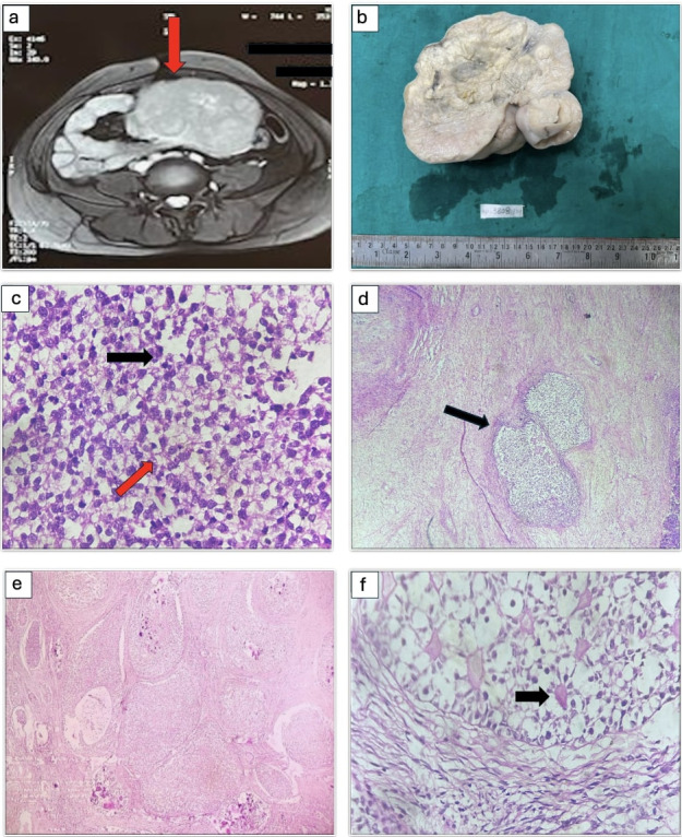 Unveiling the Uncommon: A Case Series on Rare Germ Cell Tumors.