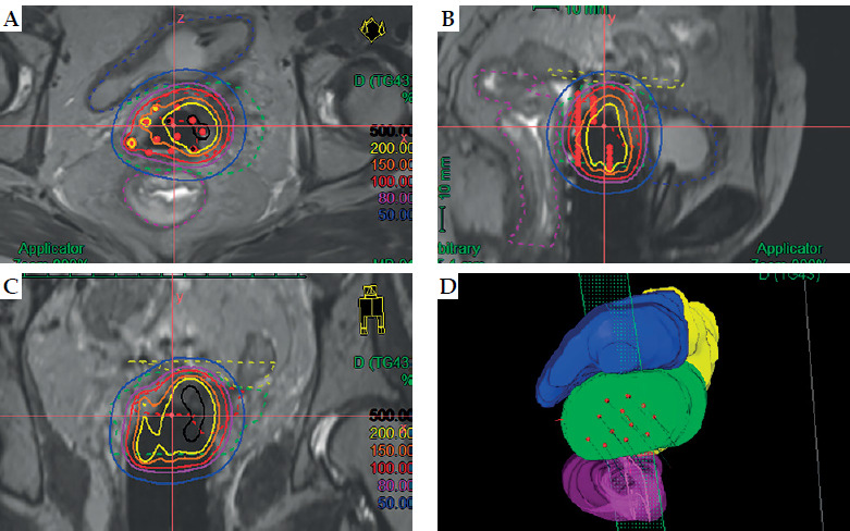 Freiburg flap used as vaginal applicator with/without free-hand interstitial needles in three-dimensional high-dose-rate brachytherapy for vaginal stump recurrence of cervical cancer.