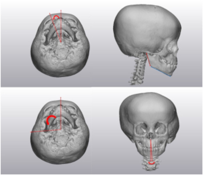 Three-dimensional Analysis of Facial Asymmetry in Unilateral Lambdoid Craniosynostosis.