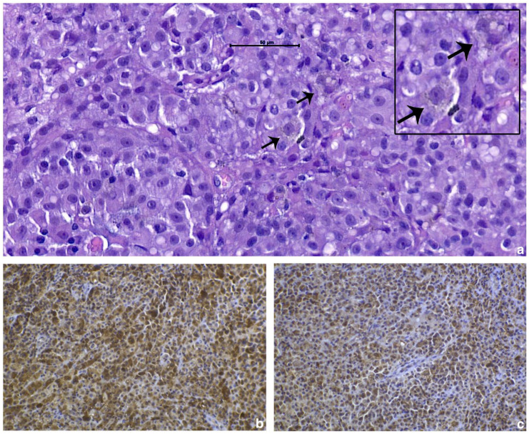 First description of oesophageal melanoma in a cat and palliative treatment by endoscopic argon plasma coagulation laser.