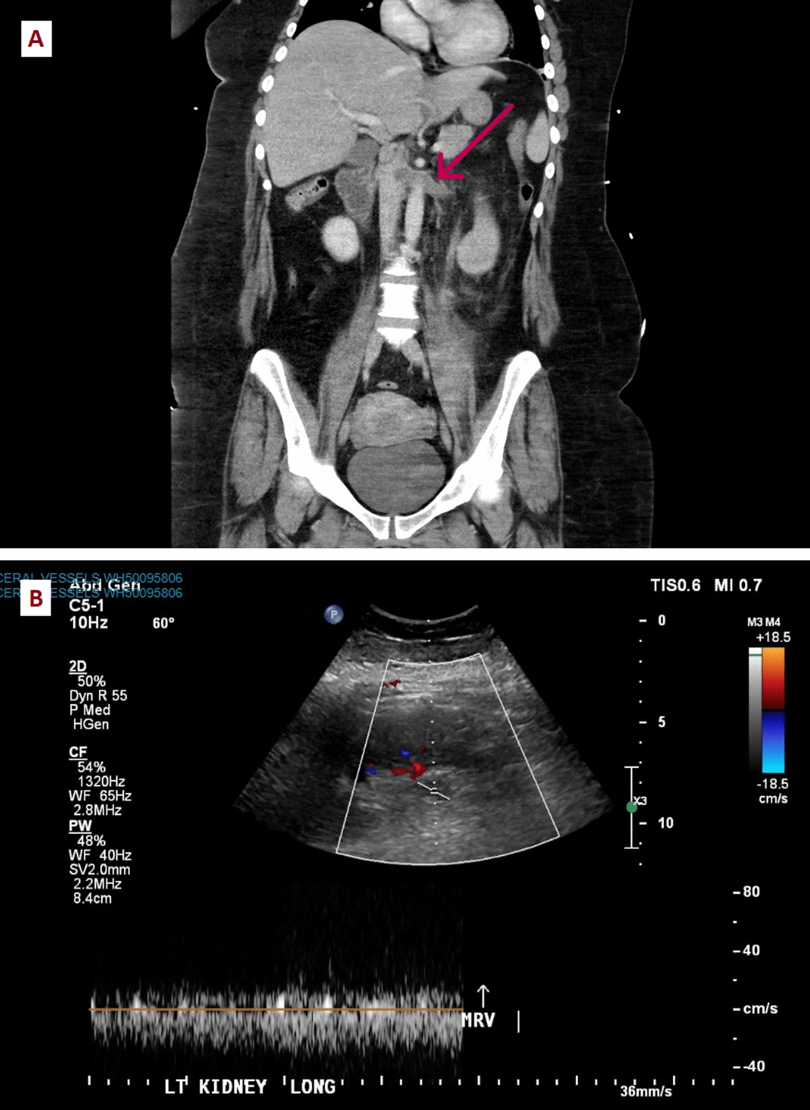 Bilateral adrenal hemorrhage in a postpartum woman with multiple thromboemboli: A case report.