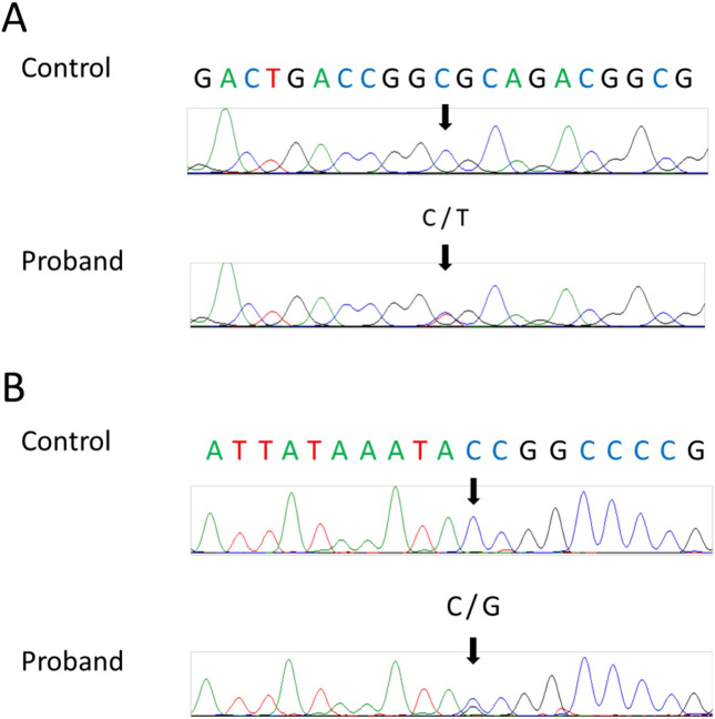 CHARGE syndrome in a child with a <i>CHD7</i> variant and a novel pathogenic <i>SOX2</i> variant: A case report.