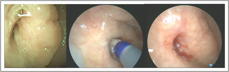 The case for balloon eustachian tuboplasty in children.