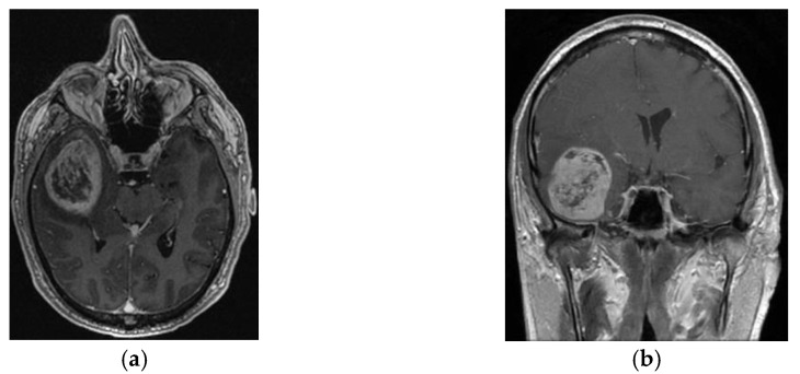 Efficacy and Cognitive Outcomes of Gamma Knife Radiosurgery in Glioblastoma Management for Elderly Patients.