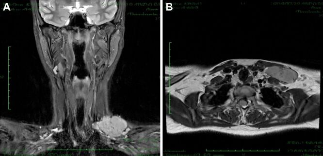 Castleman disease as the great mimicker: the role of complex morpho-pathological evaluation.