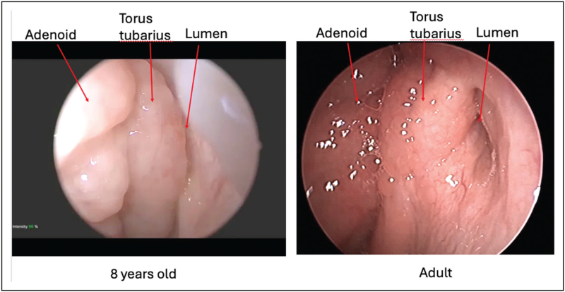 The case for balloon eustachian tuboplasty in children.
