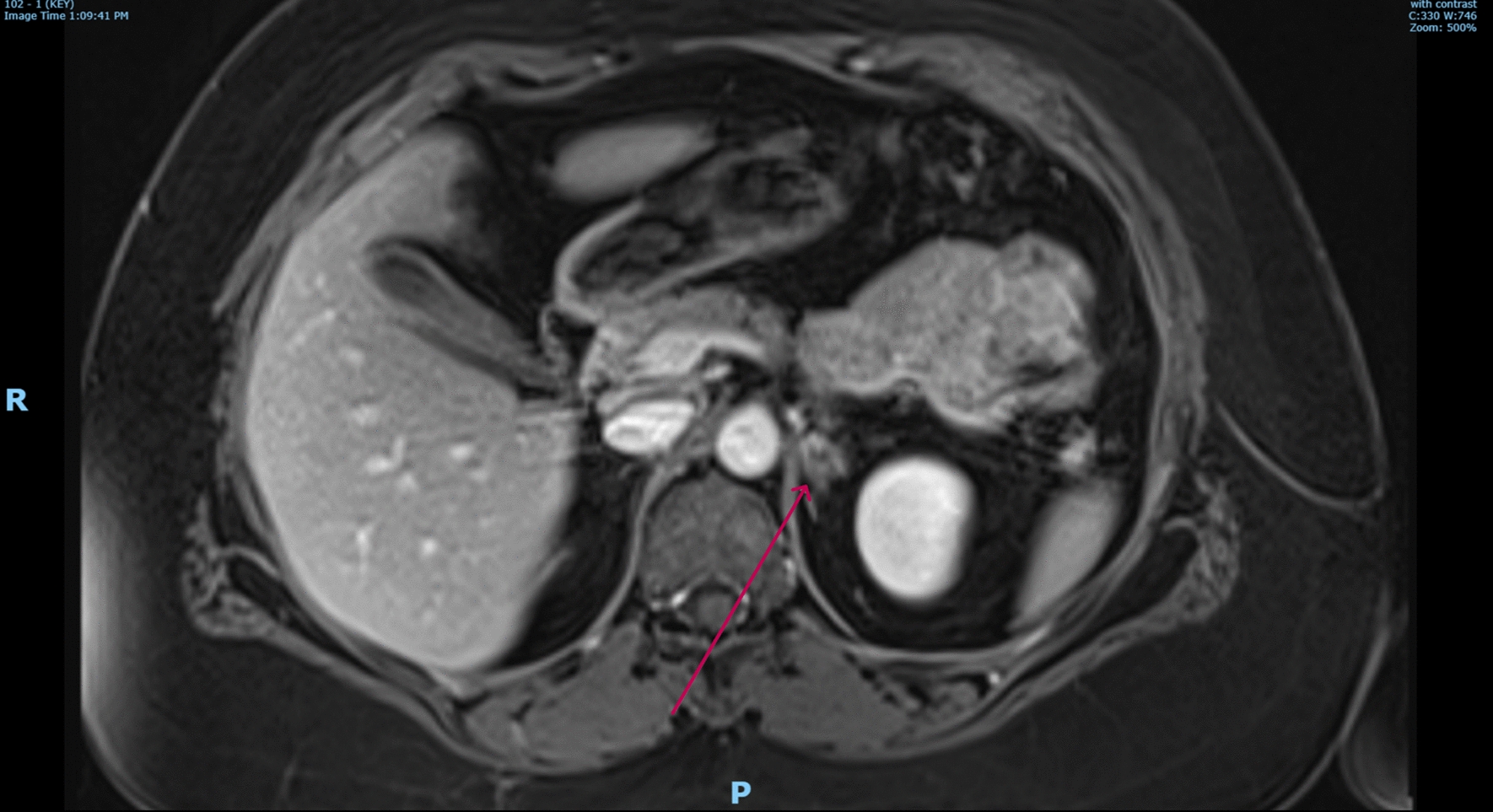Bilateral adrenal hemorrhage in a postpartum woman with multiple thromboemboli: A case report.