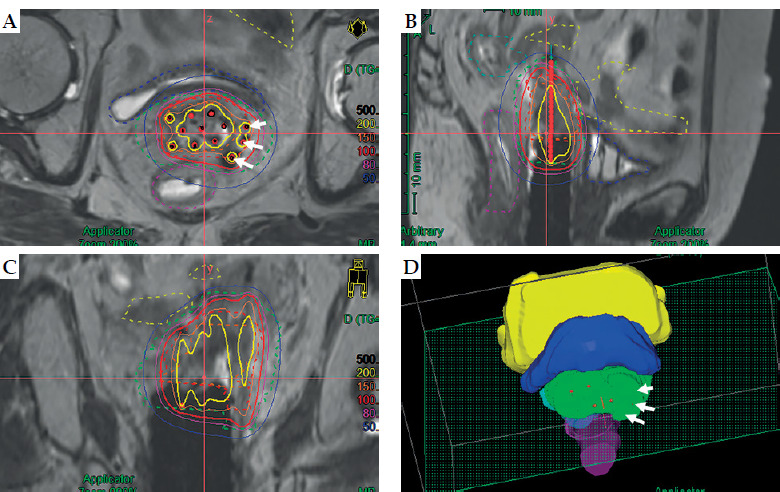 Freiburg flap used as vaginal applicator with/without free-hand interstitial needles in three-dimensional high-dose-rate brachytherapy for vaginal stump recurrence of cervical cancer.