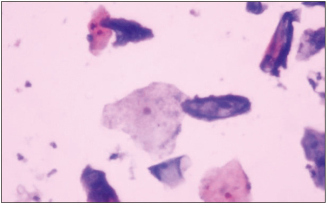 A Diagnostic Study Using STARD Platform on Liquid-Based Cytology in Cervical Smear and Its Positivity Rate among Females with Abnormal Vaginal Conditions Attending a Tertiary Care Center.