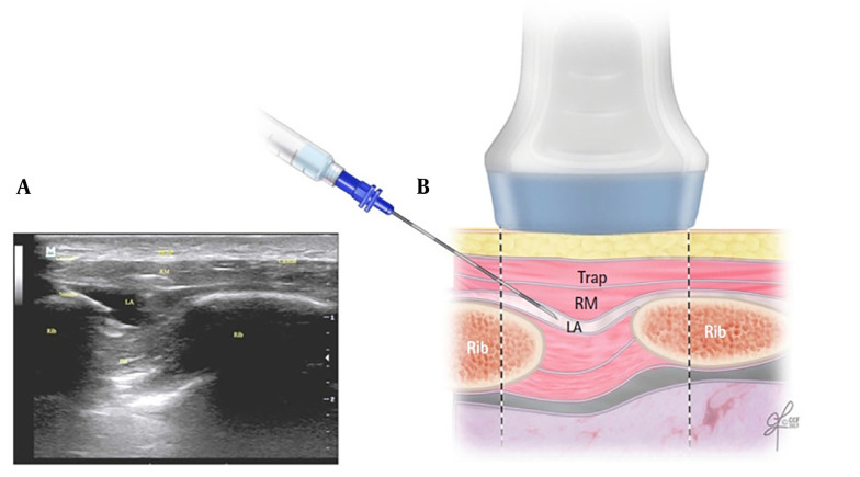 The Effectiveness and Safety of Rhomboid Intercostal Block for Postoperative Pain Management in Thoracic and Breast Surgical Procedures: A Meta-analysis.