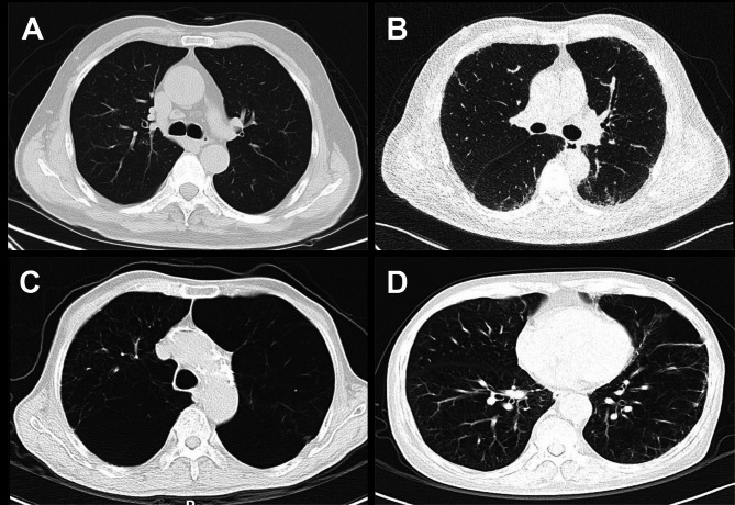 Interstitial lung abnormality in COPD is inversely associated with the comorbidity of lung cancer.