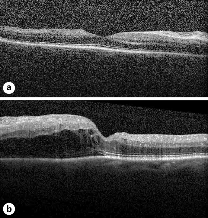 Working under Pressure: Scleroderma Presenting with Bilateral Exudative Retinal Detachment in the Context of Scleroderma Renal Crisis: A Case Report.
