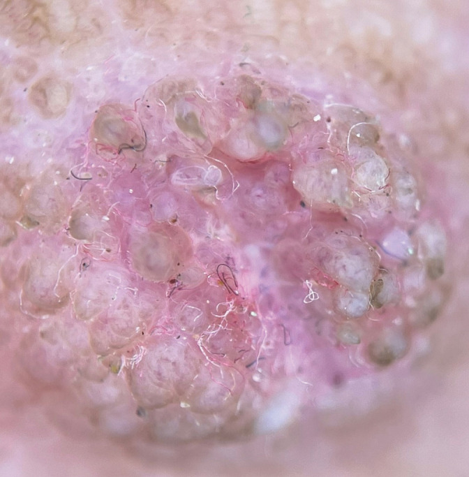Dermoscopy of nevoid hyperkeratosis of the nipple and/or areola in Fitzpatrick skin type IV.