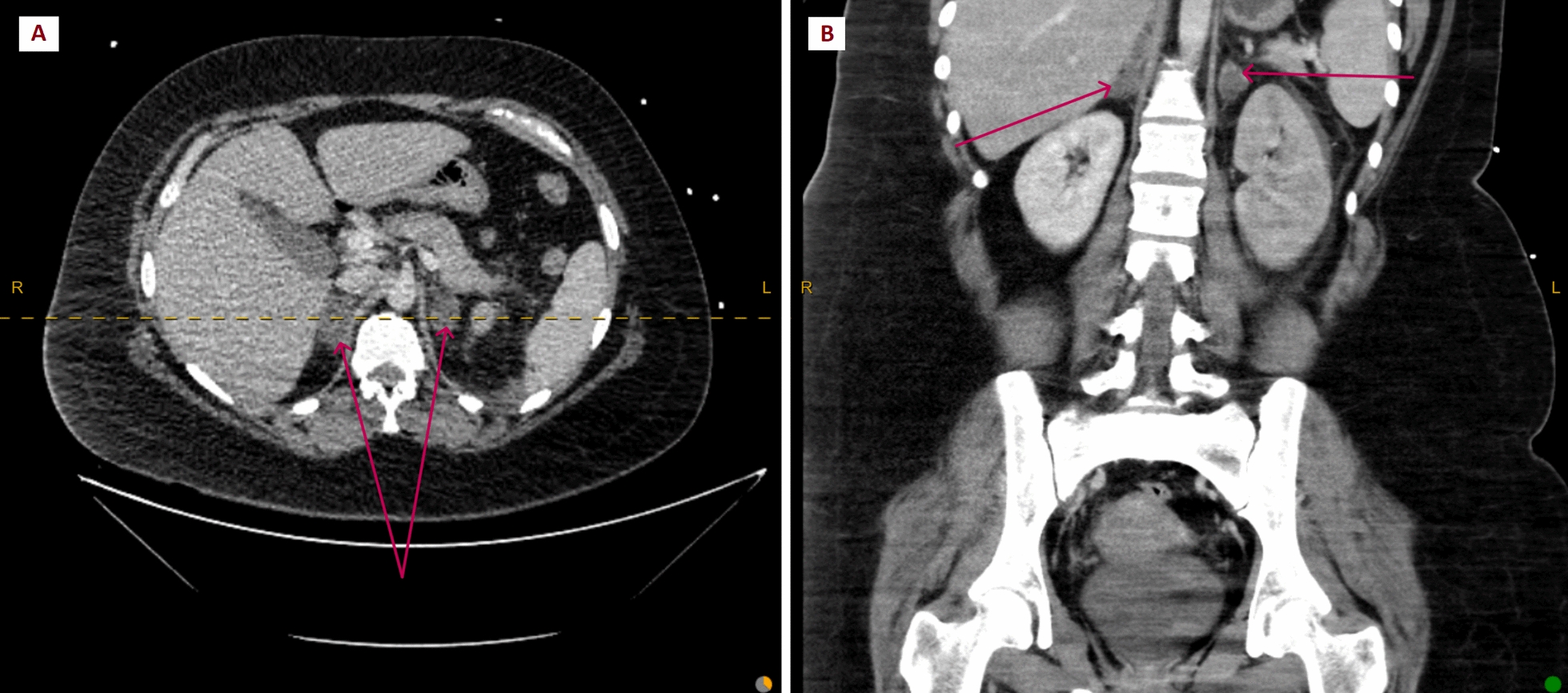 Bilateral adrenal hemorrhage in a postpartum woman with multiple thromboemboli: A case report.