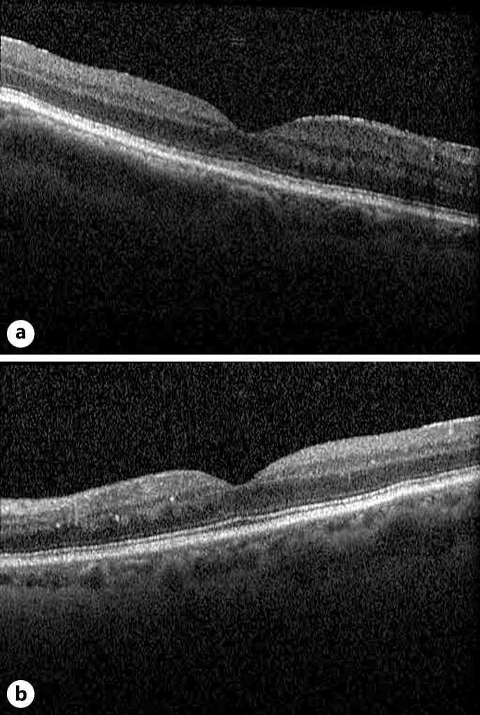 Working under Pressure: Scleroderma Presenting with Bilateral Exudative Retinal Detachment in the Context of Scleroderma Renal Crisis: A Case Report.