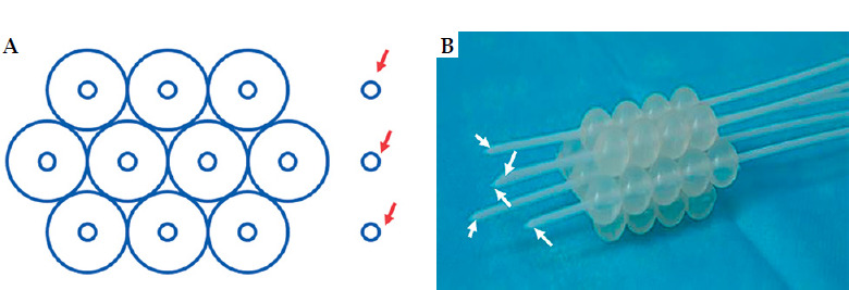 Freiburg flap used as vaginal applicator with/without free-hand interstitial needles in three-dimensional high-dose-rate brachytherapy for vaginal stump recurrence of cervical cancer.