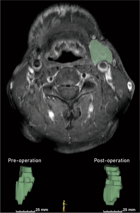 Volume changes in the contralateral submandibular gland following unilateral gland excision in oral cancer patients.