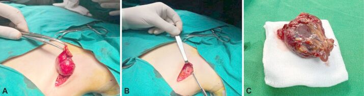 Castleman disease as the great mimicker: the role of complex morpho-pathological evaluation.