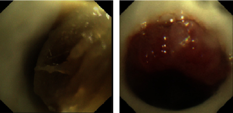 Clinical Analysis of 32 Cases of Subglottic Benign Airway Stenosis Treated With Montgomery T Silicone Stent.