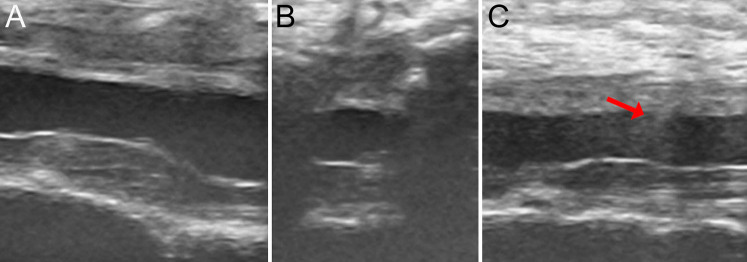 Minimally invasive management of a spinal arachnoid cyst with ultrasound-assisted catheter placement: illustrative case.