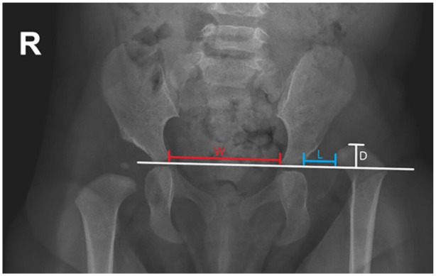 Outcomes of open reduction for hip dislocations in children with connective tissue disorders.