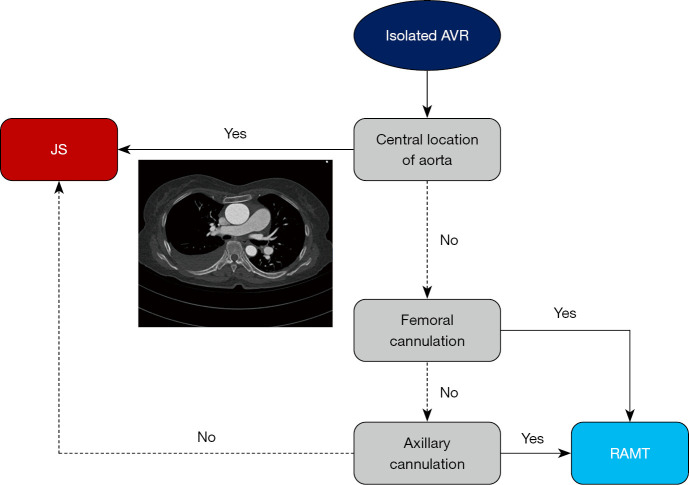 Right anterior mini-thoracotomy as first-line strategy for isolated aortic valve replacement: a retrospective study.