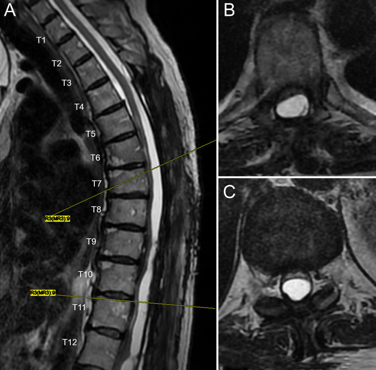 Minimally invasive management of a spinal arachnoid cyst with ultrasound-assisted catheter placement: illustrative case.
