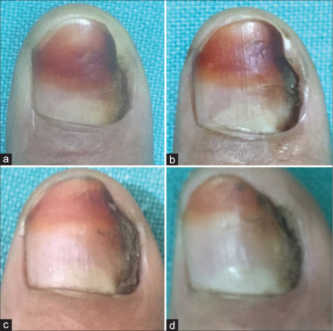 Therapeutic pearl: Chemical sealing of the nail plate and its gutter for treating lateral nail plate dystrophy of the fingernail.