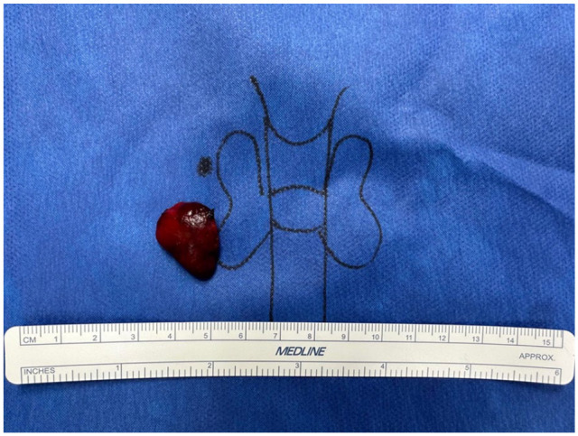 Primary Hyperparathyroidism With Undetectable Intact Parathyroid Hormone.