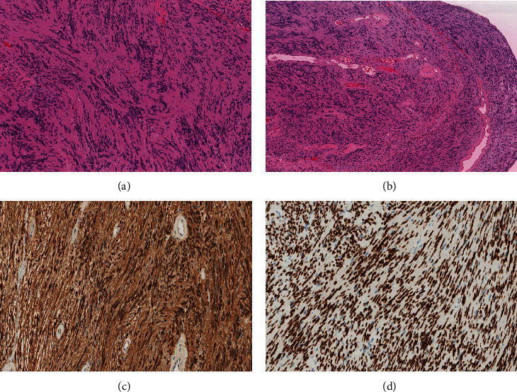 Sellar Schwannoma Masquerading as Giant Pituitary Adenoma: A Diagnostic Challenge.