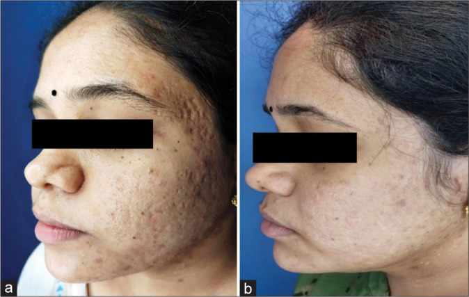 Efficacy and safety of microneedling radiofrequency in acne scars.