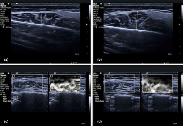 Dextrose neuroprolotherapy and occlusal splint treatment outcomes in occlusal trauma: Evaluation through ultrasound imaging.