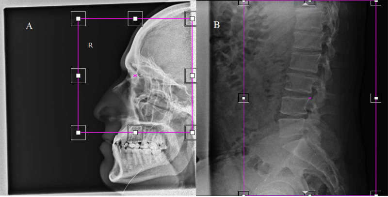 Impact of Electronic Collimation on Reducing Unnecessary Patient Dose in Digital Radiography.