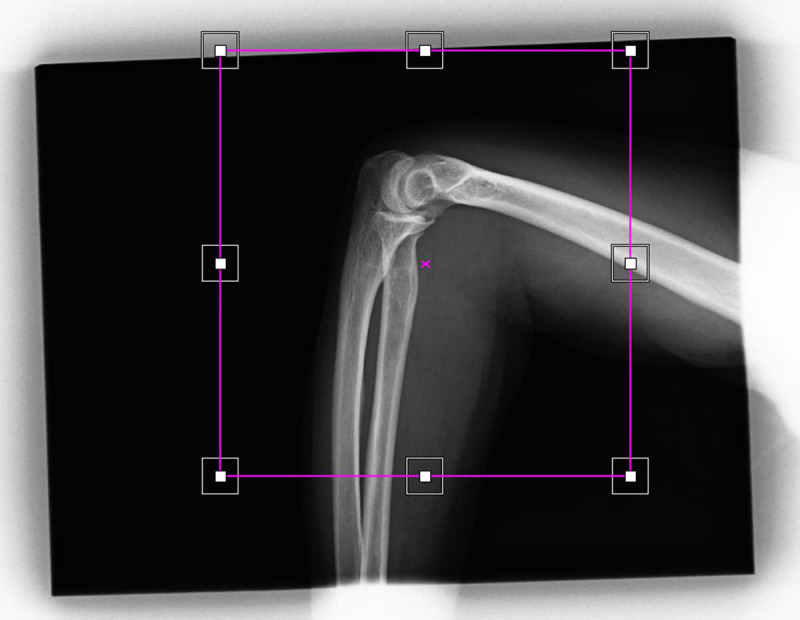 Impact of Electronic Collimation on Reducing Unnecessary Patient Dose in Digital Radiography.