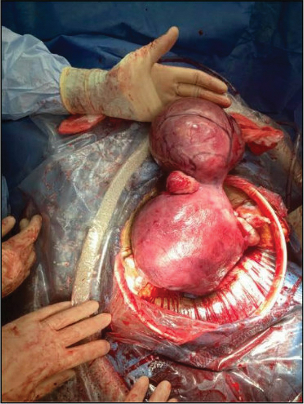 Hemorrhaging Uterine Fibroid Leading to Emergent Early Term Cesarean Delivery: A Case Report.